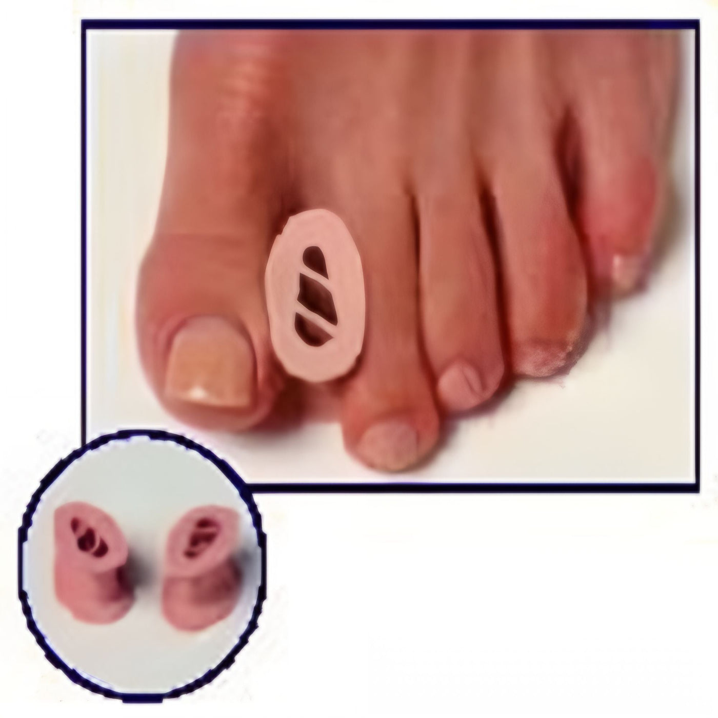 Toe Spreader - Pack of 12